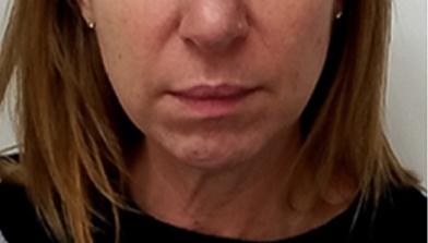 Result patient before