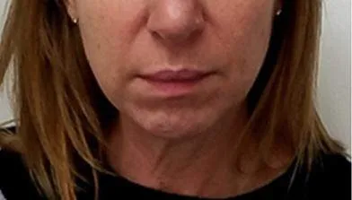 Result patient before