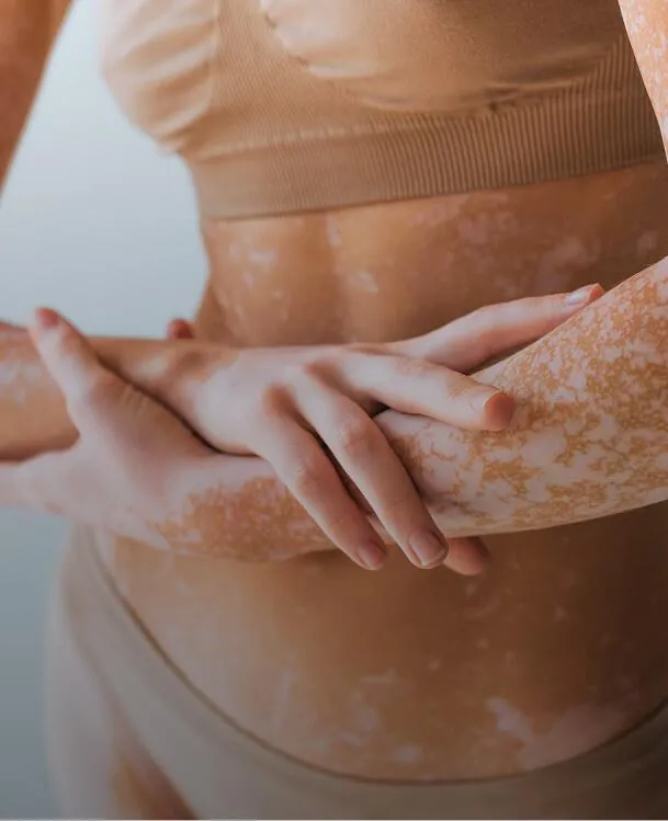 <p class="p1"><b>Psoriasis,</b><b>Vitiligo</b></p>
 image