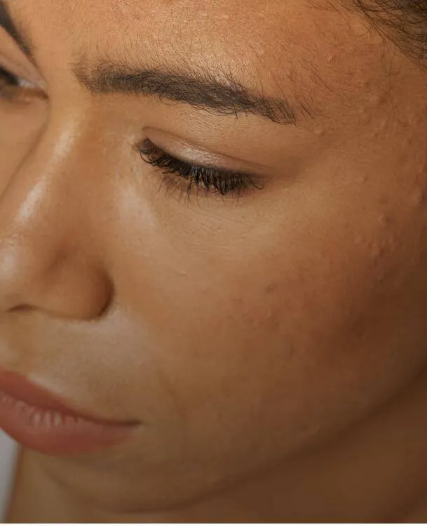 <p>Acne Scars, Stretch Marks</p>
 image