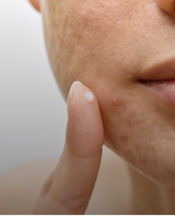 <p>Rosacea, Vascular Lesions</p>
image