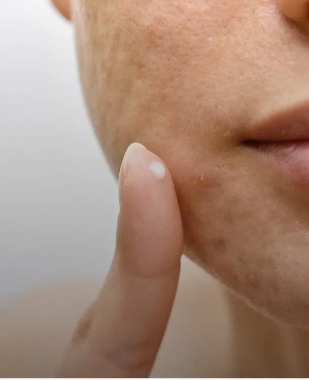 <p>Rosacea, Vascular Lesions</p>
 image