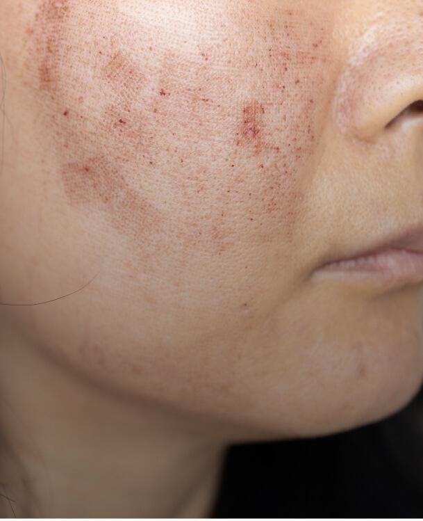 <p>Skin rejuvenation, pigmentation, acne scars</p>
image