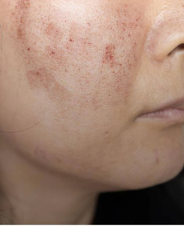 <p>Skin rejuvenation, pigmentation, acne scars</p>
 image