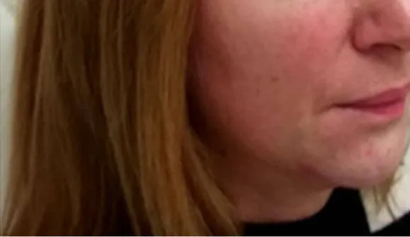 Result patient after