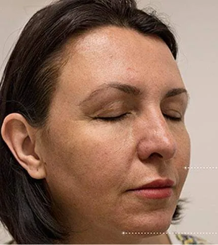 Result patient before