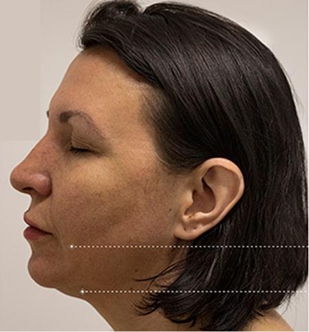 Result patient before