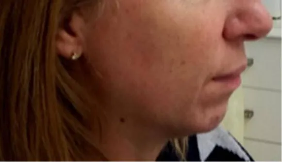 Result patient before