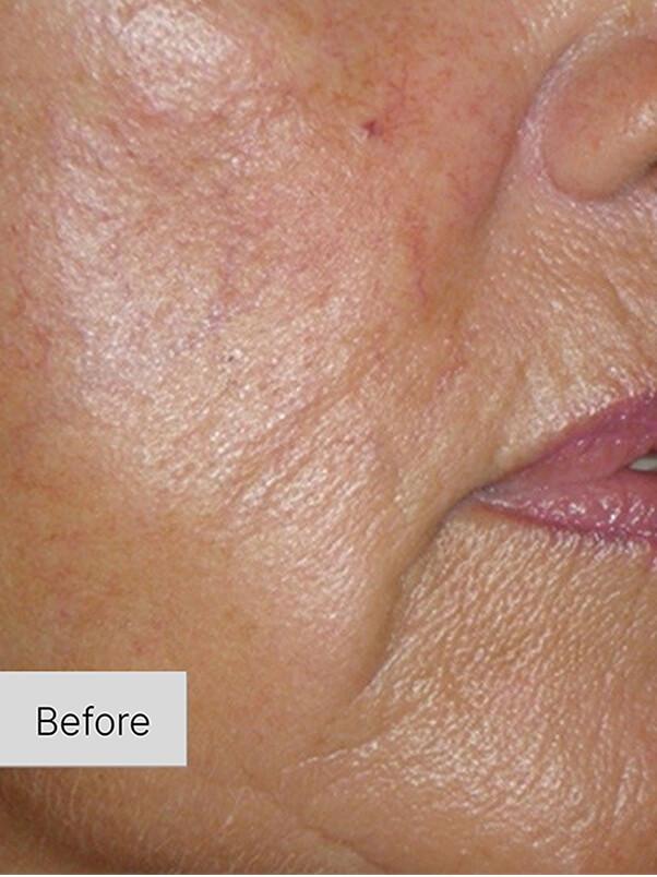 Collagen Treatment in action
 before result