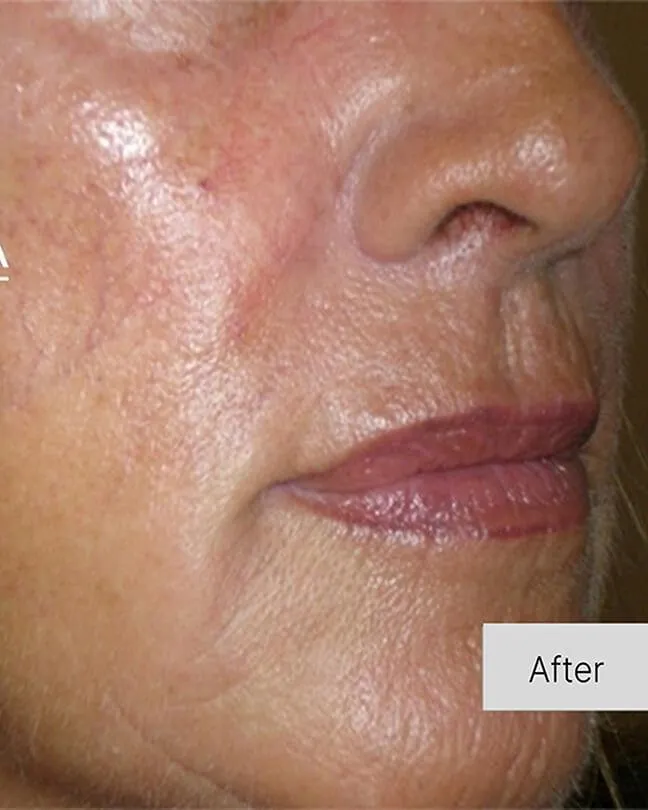 Skinboosters in action after results