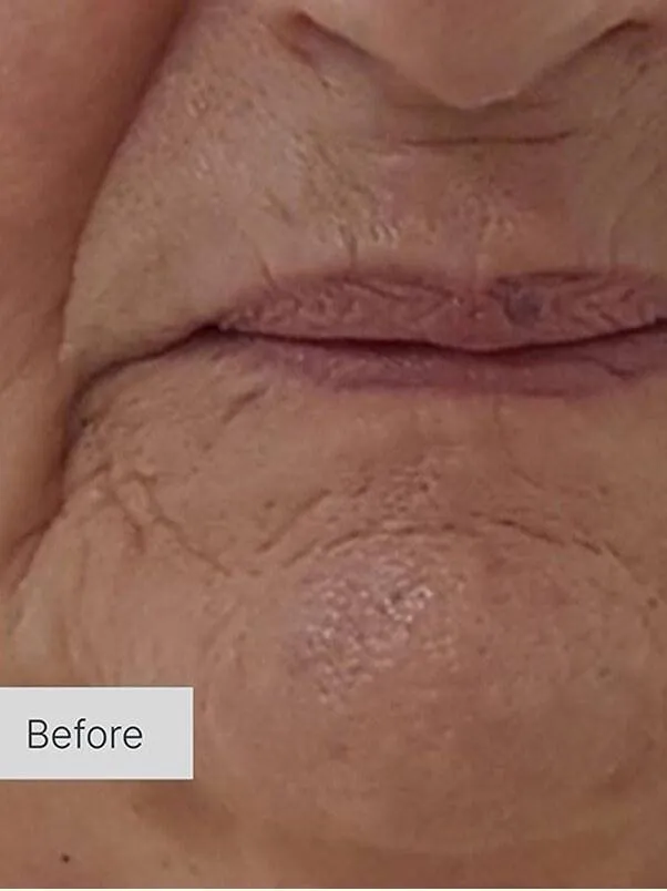 Skinboosters in action before results
