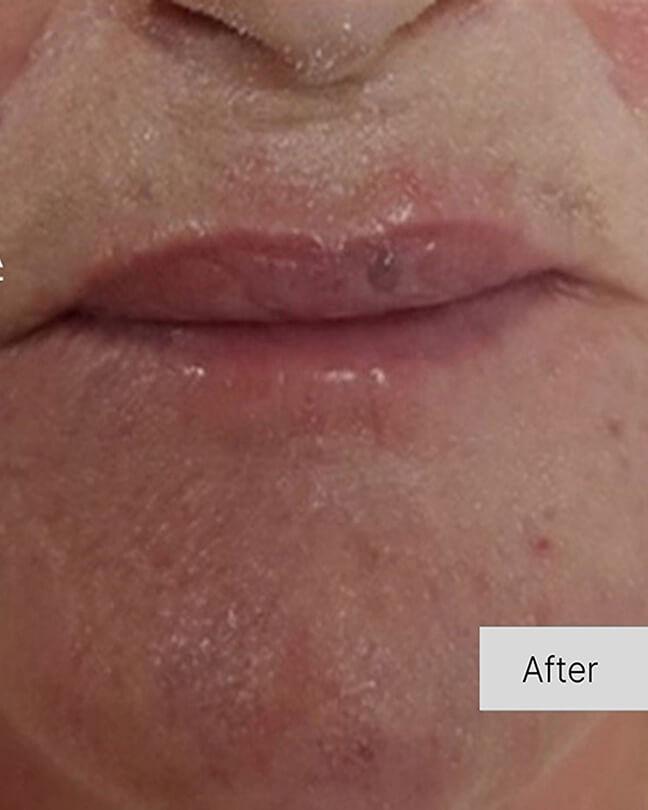 Collagen Treatment in action
 after result