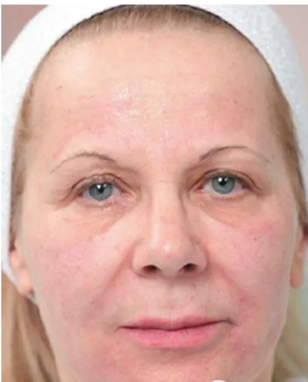 Skinboosters in action after results