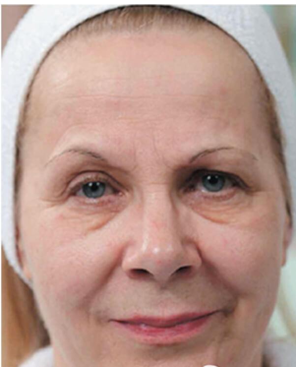 Skinboosters in action before results