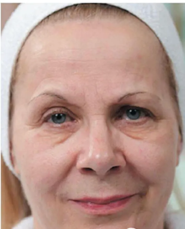 Skinboosters in action before results