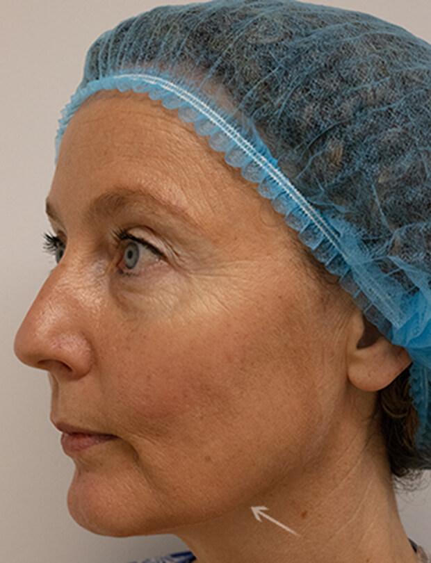 Silhouette Soft treatment  in action after results