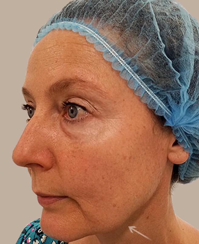 Silhouette Soft treatment  in action before results