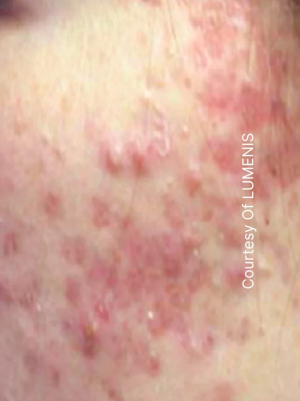 CO2 Resurfacing treatment in action
 before result