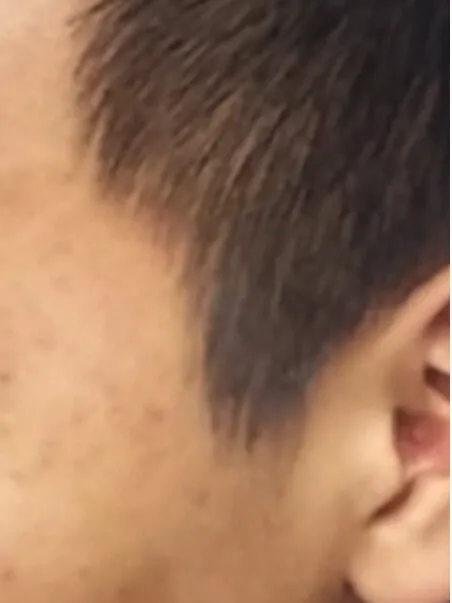 Acne treatment in action
 after result