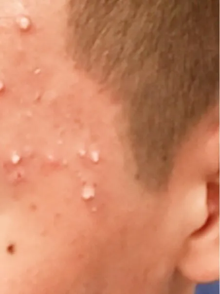 Acne treatment in action
 before result