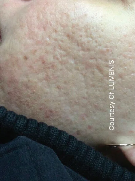 CO2 Resurfacing treatment in action
 before result