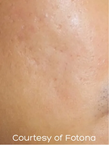 Acne scarring treatment in action
 after result
