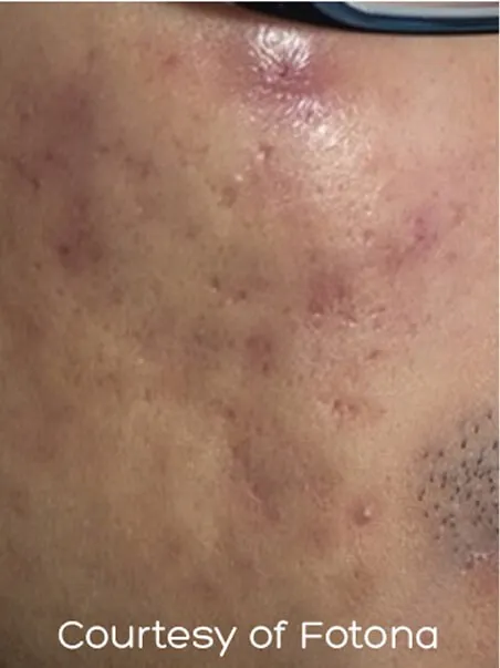 Acne scarring treatment in action
 before result