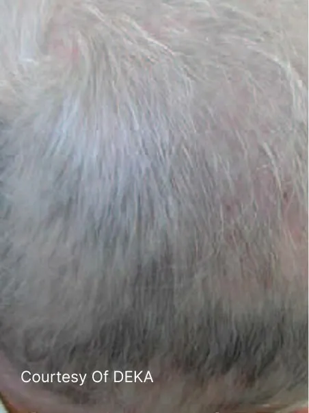 Alopecia treatment in action
 after result