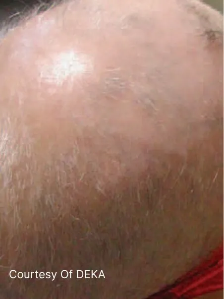 Alopecia treatment in action
 before result
