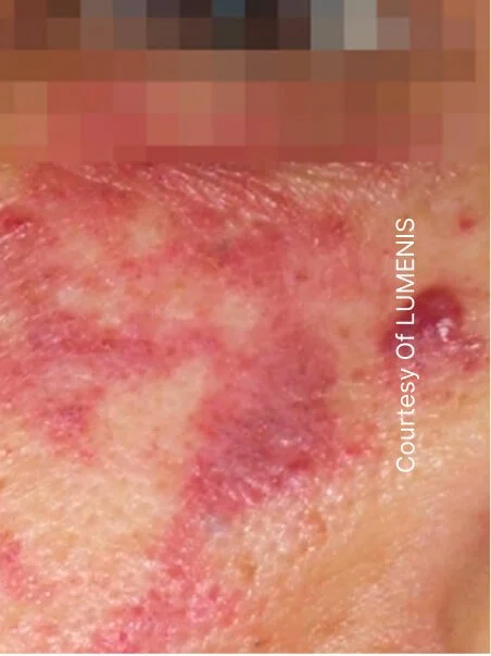 CO2 Resurfacing treatment in action
 before result