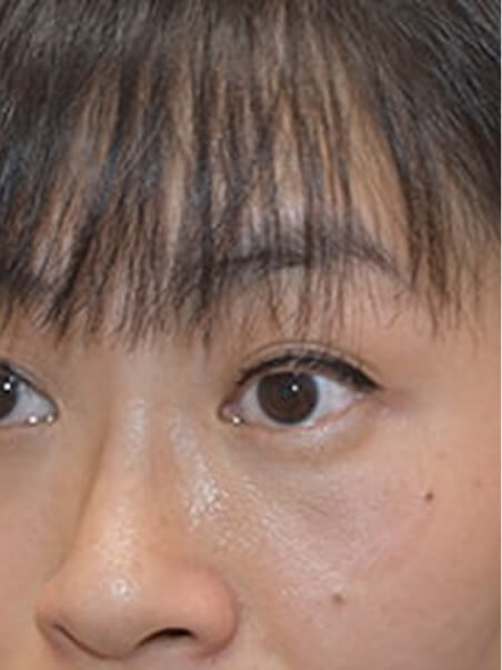 Birthmark treatment in action
 after result