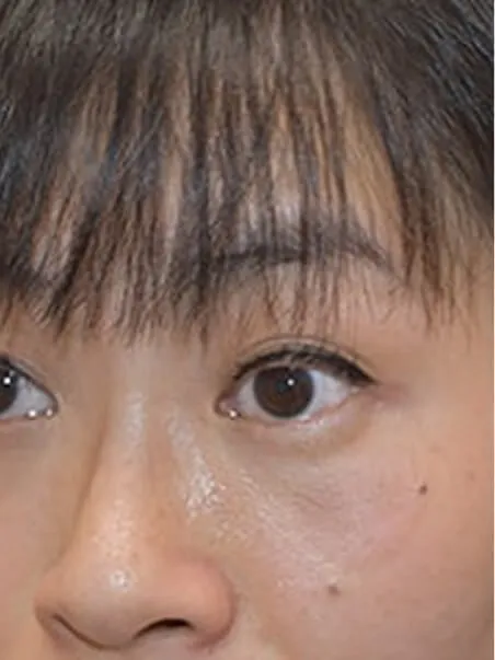 Birthmark treatment in action after result