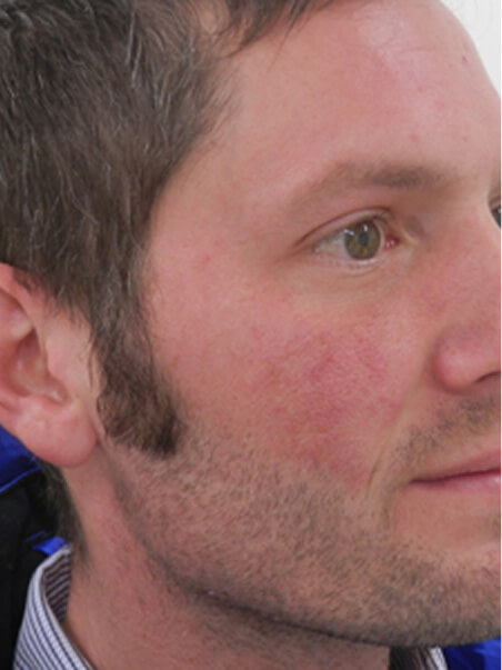 Birthmark treatment in action
 after result