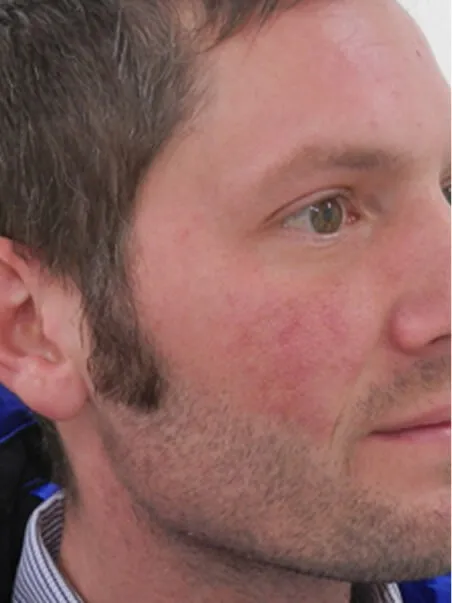 Birthmark treatment in action after result