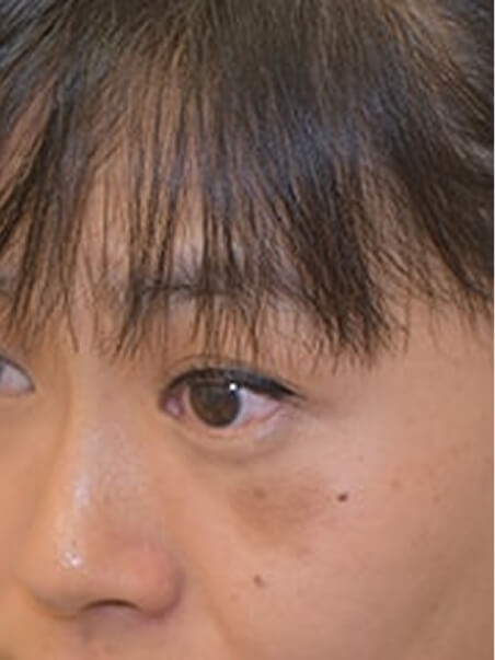 Birthmark treatment in action
 before result