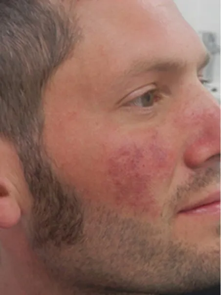Birthmark treatment in action before result