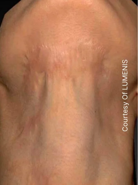 CO2 Resurfacing treatment in action after result
