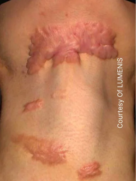 CO2 Resurfacing treatment in action before result