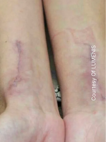 CO2 Resurfacing treatment in action before result