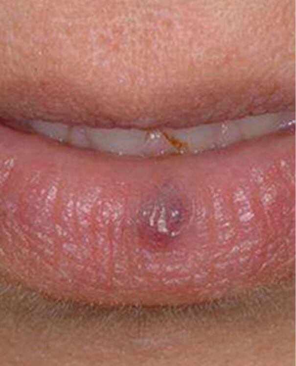 Cherry Angiomas