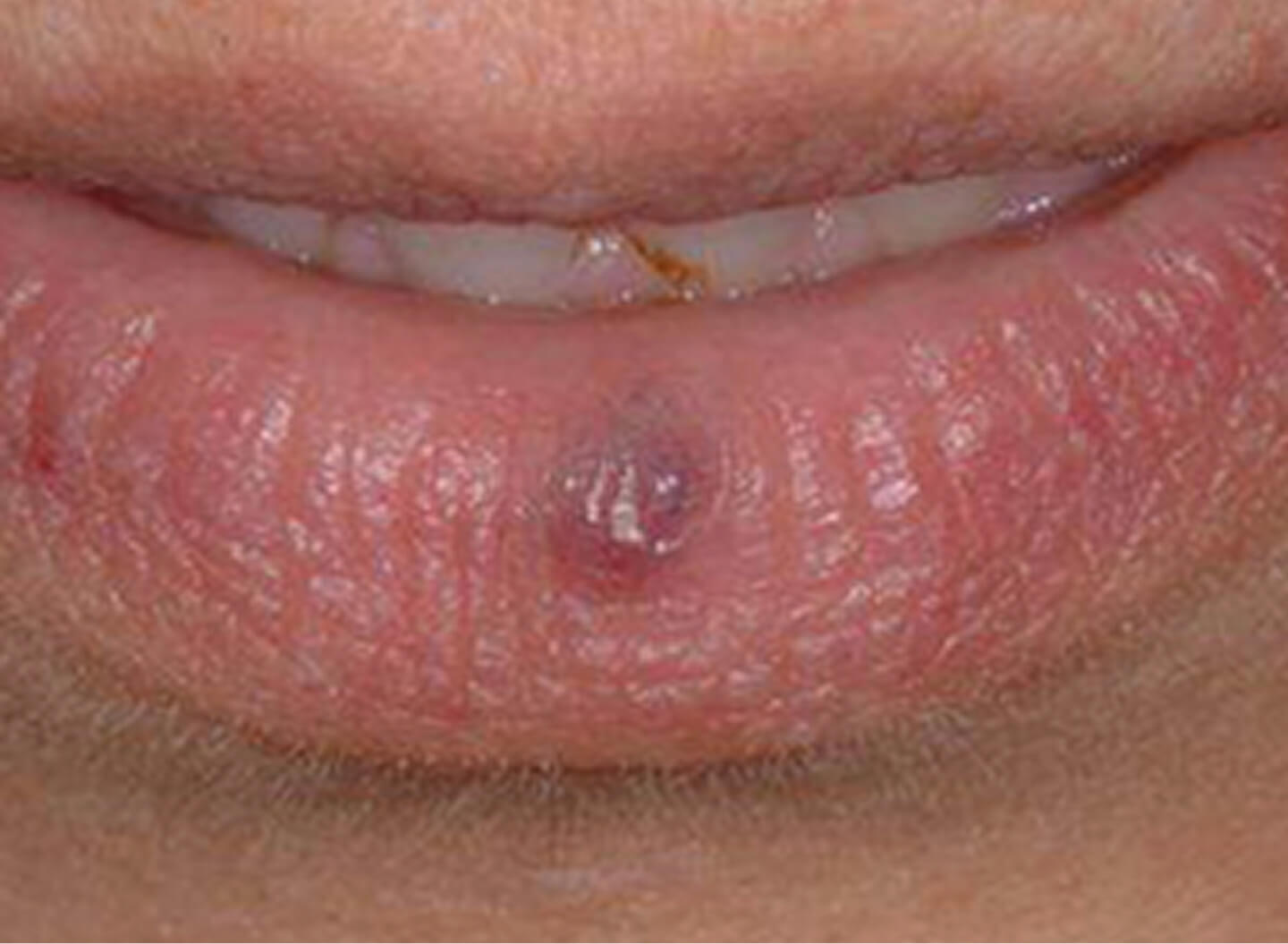 Cherry Angiomas