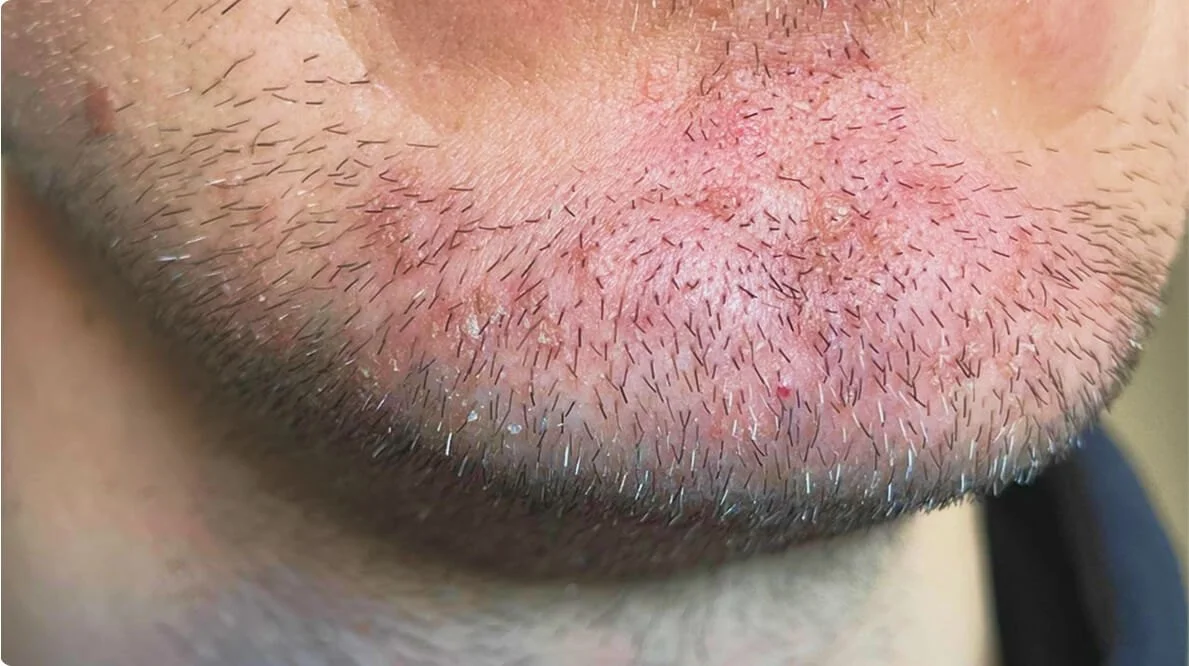 Eczema on Face, Scalp and Eyelids