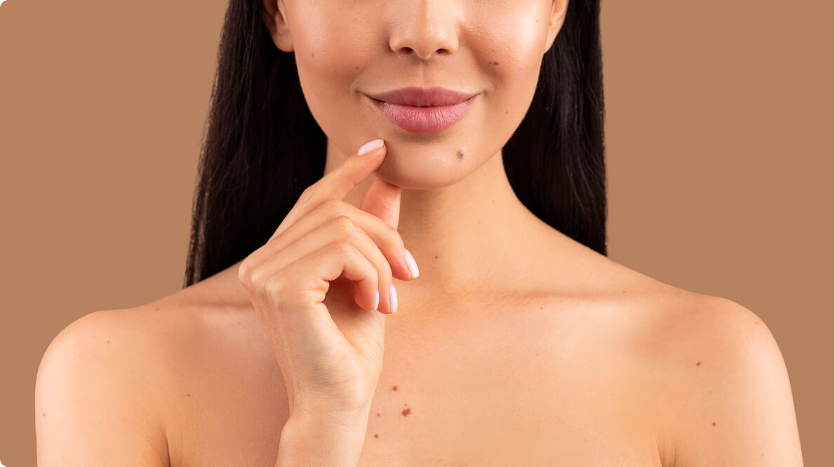 Expert Birthmark Removal for Local and Visiting Patients