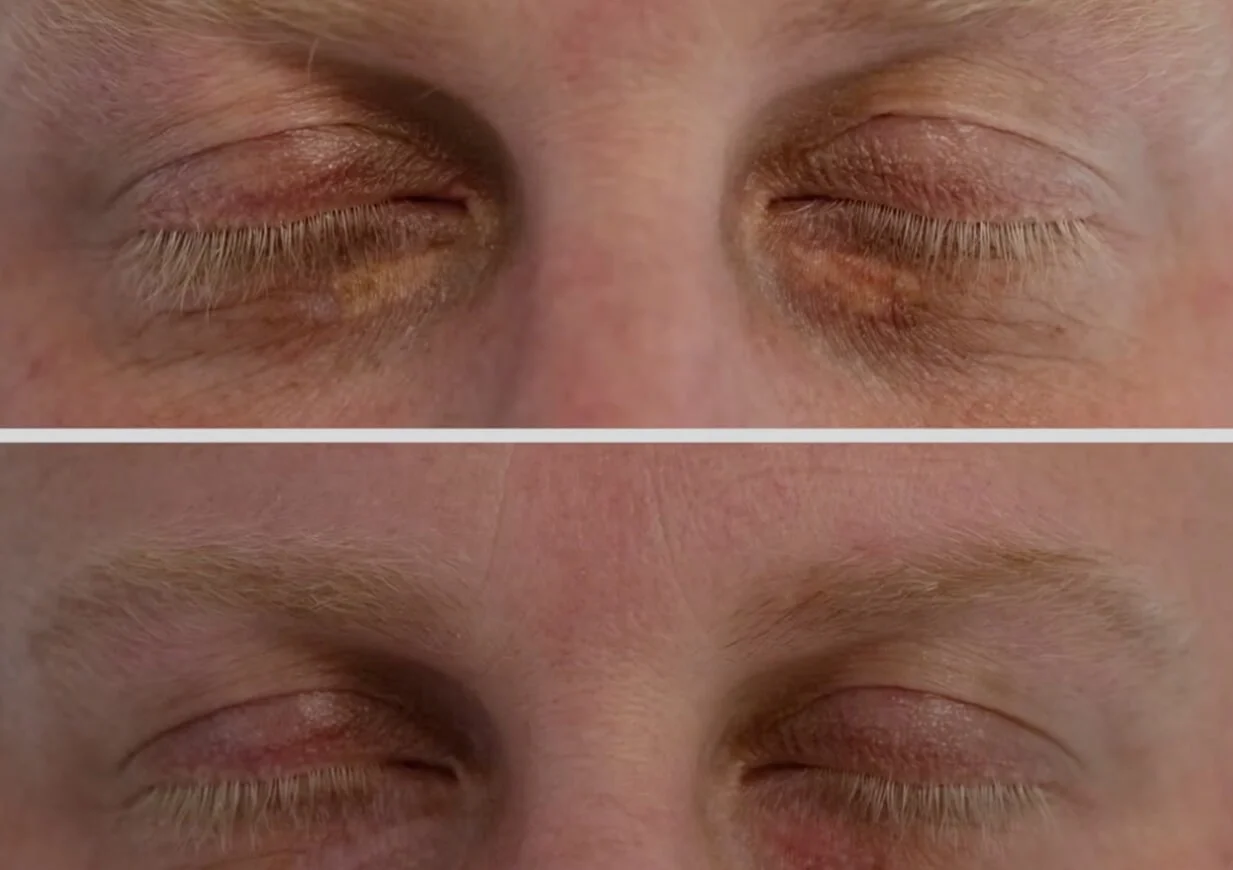 How to recognise xanthelasma