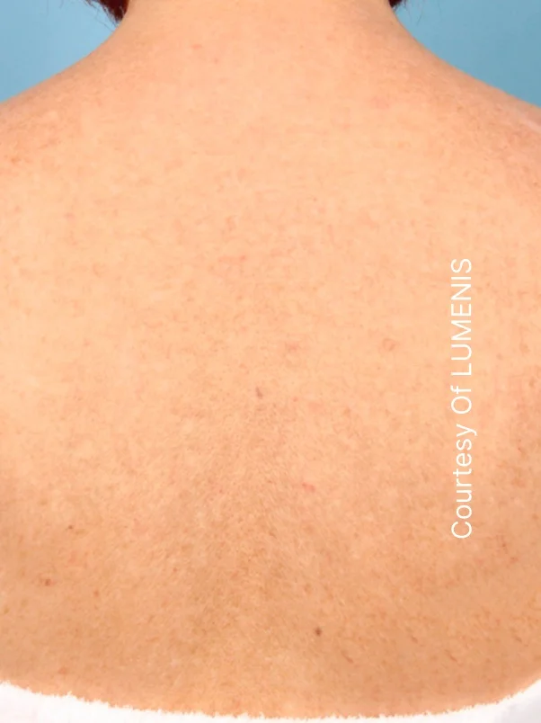CO2 Resurfacing treatment in action
 after result