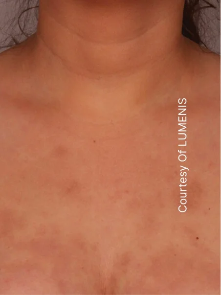 CO2 Resurfacing treatment in action
 before result