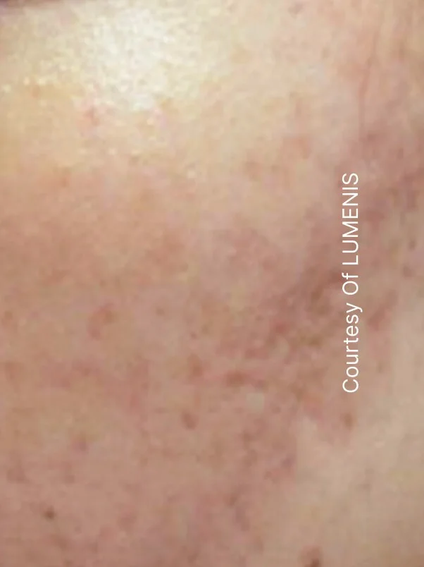 CO2 Resurfacing treatment in action
 after result