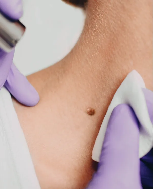 Checking Moles Checking Moles - rtwskin clinic