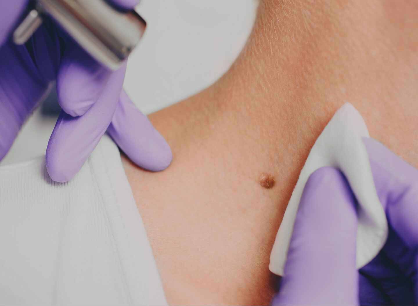 Mole Diagnosis,  Biopsies & Removal