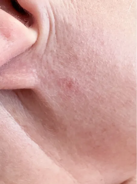 Moles Removal treatment in action
 after result